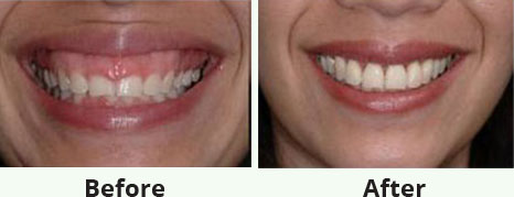 gum-image